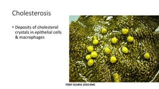 Cholesterosis
• Deposits of cholesterol
crystals in epithelial cells
& macrophages
TONY SCARIA 2010 KMC
 