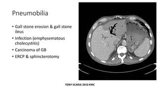 Pneumobilia
• Gall stone erosion & gall stone
ileus
• Infection (emphysematous
cholecystitis)
• Carcinoma of GB
• ERCP & sphincterotomy
TONY SCARIA 2010 KMC
 