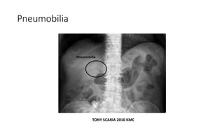 Pneumobilia
TONY SCARIA 2010 KMC
 