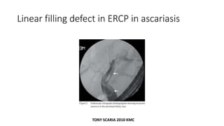Linear filling defect in ERCP in ascariasis
TONY SCARIA 2010 KMC
 