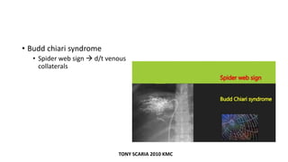 • Budd chiari syndrome
• Spider web sign  d/t venous
collaterals
TONY SCARIA 2010 KMC
 