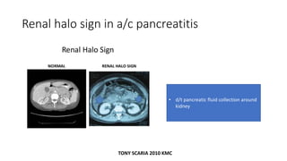 Renal halo sign in a/c pancreatitis
• d/t pancreatic fluid collection around
kidney
TONY SCARIA 2010 KMC
 