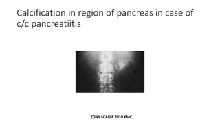 Calcification in region of pancreas in case of
c/c pancreatiitis
TONY SCARIA 2010 KMC
 