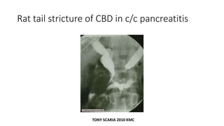Rat tail stricture of CBD in c/c pancreatitis
TONY SCARIA 2010 KMC
 