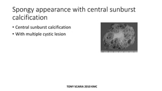 Spongy appearance with central sunburst
calcification
• Central sunburst calcification
• With multiple cystic lesion
TONY SCARIA 2010 KMC
 
