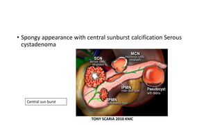 • Spongy appearance with central sunburst calcification Serous
cystadenoma
Central sun burst
TONY SCARIA 2010 KMC
 