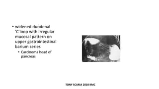 • widened duodenal
'C'loop with irregular
mucosal pattern on
upper gastrointestinal
barium series
• Carcinoma head of
pancreas
TONY SCARIA 2010 KMC
 