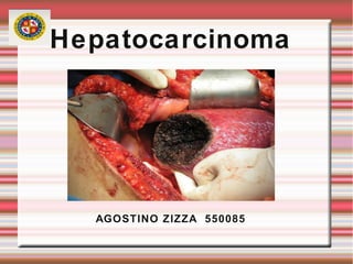 Hepatocarcinoma
AGOSTINO ZIZZA 550085
 