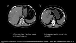 • 80% hepatocitos : Proteinas, grasas,
ferritina y glucogeno.
• Indices de atenuación normal entre
50-60 UH.
Tomasz K. Nowicki*, Karolina Markiet and Edyta Szurowska Diagnostic Imaging of Hepatocellular Carcinoma - A Pictorial Essay Current Medical Imaging Reviews, 2017, 13,
140-153
 