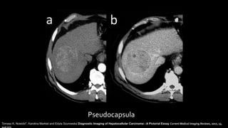Pseudocapsula
Tomasz K. Nowicki*, Karolina Markiet and Edyta Szurowska Diagnostic Imaging of Hepatocellular Carcinoma - A Pictorial Essay Current Medical Imaging Reviews, 2017, 13,
140-153
 
