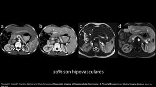 20% son hipovasculares
Tomasz K. Nowicki*, Karolina Markiet and Edyta Szurowska Diagnostic Imaging of Hepatocellular Carcinoma - A Pictorial Essay Current Medical Imaging Reviews, 2017, 13,
140-153
 