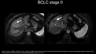 BCLC stage 0
Sinead H. McEvoy, MBBCh, FFRRCSI • Colin J. McCarthy, MBBCh Hepatocellular Carcinoma: Illustrated Guide to Systematic Radiologic Di- agnosis and Staging According to Guidelines of the
American Associa- tion for the Study of Liver Diseases RadioGraphics 2013; 33:1653–1668
 