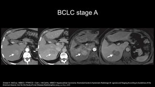 BCLC stage A
Sinead H. McEvoy, MBBCh, FFRRCSI • Colin J. McCarthy, MBBCh Hepatocellular Carcinoma: Illustrated Guide to Systematic Radiologic Di- agnosis and Staging According to Guidelines of the
American Associa- tion for the Study of Liver Diseases RadioGraphics 2013; 33:1653–1668
 