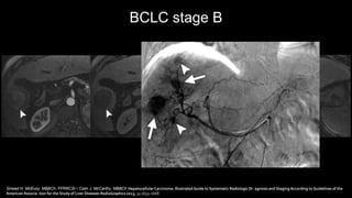 BCLC stage B
Sinead H. McEvoy, MBBCh, FFRRCSI • Colin J. McCarthy, MBBCh Hepatocellular Carcinoma: Illustrated Guide to Systematic Radiologic Di- agnosis and Staging According to Guidelines of the
American Associa- tion for the Study of Liver Diseases RadioGraphics 2013; 33:1653–1668
 