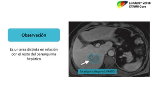 Observación
Es un area distinta en relación
con el resto del parenquima
hepático
Se asigna categoria LI-RADS
 