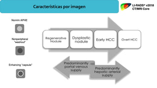 Realce no anular del tumor mayor
que el resto del parenquima
hepatico.
Lavado no periferico en fase
portovenosa y tardia, aun sin
realce en la fase arterial.
Medicioón de borde exterior a
borde exterior en el eje mas largo,
incluir la capsula.
Aumento de tamaño de una masa
en ≥ 50% en ≤ 6 meses
Bordes lisos, bien definidos,
notablemente mas gruesos que el
resto del tejido fibrotico de
regeneración alrededor, el cual
tiene un realce en corona en la fase
PV y tardia.
Características por imagen
 