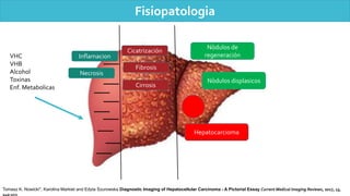 Fisiopatologia
VHC
VHB
Alcohol
Toxinas
Enf. Metabolicas
Inflamacion
Necrosis
Cicatrización
Fibrosis
Cirrosis
Nòdulos de
regeneración
Nòdulos displasicos
Hepatocarcioma
Tomasz K. Nowicki*, Karolina Markiet and Edyta Szurowska Diagnostic Imaging of Hepatocellular Carcinoma - A Pictorial Essay Current Medical Imaging Reviews, 2017, 13,
140-153
 
