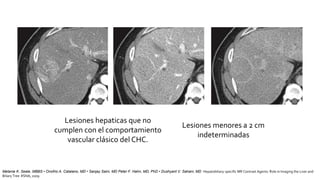 Melanie K. Seale, MBBS • Onofrio A. Catalano, MD • Sanjay Saini, MD Peter F. Hahn, MD, PhD • Dushyant V. Sahani, MD Hepatobiliary-specific MR Contrast Agents: Role in Imaging the Liver and
Biliary Tree RSNA, 2009
Lesiones hepaticas que no
cumplen con el comportamiento
vascular clásico del CHC.
Lesiones menores a 2 cm
indeterminadas
 