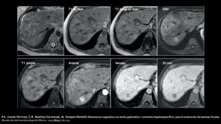 P.E. Cossio-Torricoa, C.R. Ramírez-Carmonab, M. Stoopen-Rometti Resonancia magnética con ácido gadoxético -contraste hepatoespecífico- para la evaluación de lesiones focales
Revista de Gastroenterología de México. 2015;80(4):267-275
 