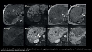 P.E. Cossio-Torricoa, C.R. Ramírez-Carmonab, M. Stoopen-Rometti Resonancia magnética con ácido gadoxético -contraste hepatoespecífico- para la evaluación de lesiones focales
Revista de Gastroenterología de México. 2015;80(4):267-275
 