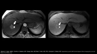 Melanie K. Seale, MBBS • Onofrio A. Catalano, MD • Sanjay Saini, MD Peter F. Hahn, MD, PhD • Dushyant V. Sahani, MD Hepatobiliary-specific MR Contrast Agents: Role in Imaging the Liver and
Biliary Tree RSNA, 2009
 