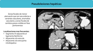 Pseudolesiones hepáticas
Localizaciones mas frecuentes:
• Segmento IV adyacente al
ligamento falciforme
• Adyacente a la vesicula
• Adyacente a la vena porta
intrahepatica
Zonas focales de menor
atenuacón que son secundarias a
variantes vasculares, anomalias
vasculares y zonas focales de
cambios grasos visibles en fase
portovenosa
 
