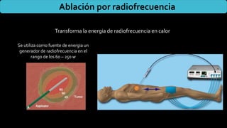 Ablación por radiofrecuencia
Transforma la energia de radiofrecuencia en calor
Se utiliza como fuente de energia un
generador de radiofrecuencia en el
rango de los 60 – 250 w
 