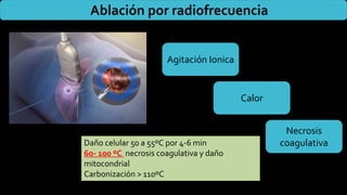 Ablación por radiofrecuencia
Agitación Ionica
Calor
Necrosis
coagulativa
Daño celular 50 a 55ºC por 4-6 min
60- 100 ºC necrosis coagulativa y daño
mitocondrial
Carbonización > 110ºC
 