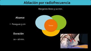 Ablación por radiofrecuencia
Alcance
• Paraguas 5 cm
Tumor
Margenes libres 5-10 mm.
Duración
10 – 16 min.
 