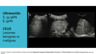 Ultrasonido
S: 33-96%
E: 90%
CEUS
Lesiones
benignas vs
malignas
Tomasz K. Nowicki*, Karolina Markiet and Edyta Szurowska Diagnostic Imaging of Hepatocellular Carcinoma - A Pictorial Essay Current Medical Imaging Reviews, 2017, 13,
140-153
 