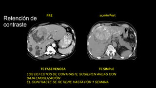 Retención de
contraste
PRE 15 min Post
TC FASEVENOSA TC SIMPLE
LOS DEFECTOS DE CONTRASTE SUGIEREN AREAS CON
BAJA EMBOLIZACIÓN
EL CONTRASTE SE RETIENE HASTA POR 1 SEMANA
 