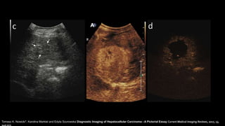 Tomasz K. Nowicki*, Karolina Markiet and Edyta Szurowska Diagnostic Imaging of Hepatocellular Carcinoma - A Pictorial Essay Current Medical Imaging Reviews, 2017, 13,
140-153
 