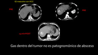 62 masculino con HCC
PRE PRE
15 min POST
Gas dentro del tumor no es patognomónico de absceso
 