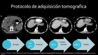 Simple Arterial
20-
30 s
• Porto-
venosa
60 s Tardía
180 s
Protocolo de adquisición tomografica
Tomasz K. Nowicki*, Karolina Markiet and Edyta Szurowska Diagnostic Imaging of Hepatocellular Carcinoma - A Pictorial Essay Current Medical Imaging Reviews, 2017, 13,
140-153
 