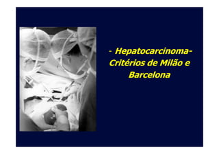 -- HepatocarcinomaHepatocarcinoma--
Critérios de Milão eCritérios de Milão e
BarcelonaBarcelonaBarcelonaBarcelona
 