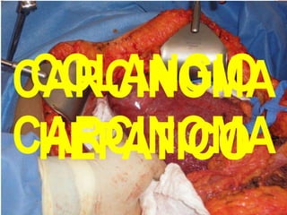 COLANGIO
CARCINOMA
CARCINOMA
 HEPATICO
 
