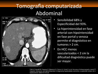 Tomografía computarizada
Abdominal
• Sensibilidad 68% y
Especificidad del 93%.
• La hiperintensidad en fase
arterial con hipointensidad
en fase portal y venosa
permite el diagnóstico en
tumores > 2 cm.
• En HCC menos
vascularizados < 2 cm la
dificultad diagnóstica puede
ser mayor.
Colli A, Fraquelli M, Casazza G, Massironi S, Colucci A, Conte D, et al. Accuracy of ultrasonography, spiral CT,
magnetic resonance, and alpha-fetoprotein in diagnosing hepatocellular carcinoma: a systematic review. Am J
Gastroenterol. 2006;101:513-23
 