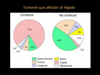 Tumores que afectan al hígado
 