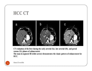 Hcc Ct Pattern Hepatocellular carcinoma | PDF