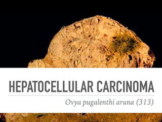 HEPATOCELLULAR CARCINOMA
Ovya pugalenthi aruna (313)
 