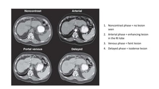 1. Noncontrast phase = no lesion
seen
2. Arterial phase = enhancing lesion
in the Rt lobe
3. Venous phase = faint lesion
4. Delayed phase = isodense lesion
 