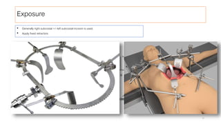 Exposure
30
• Generally right subcostal +/- left subcostal incision is used.
• Apply fixed retractors
 