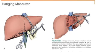 Surgical Technique
• Conventional Vs Anterior Approach for large right sided tumors
• Conventional:
• Right liver mobilization with outflow and inflow control before parenchymal transection
• Risk of tumor embolization
• Anterior:
• Inflow control, then parenchymal division, outflow control, and lastly mobilization
• Risk of bleeding
37
 