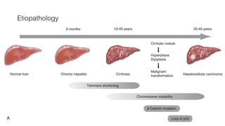 Etiopathology
Cirrhotic Pathway
• HCV
• HBV
• Alcoholic liver disease
• Autoimmune hepatitis
Noncirrhotic Pathway
• Fibrolamellar carcinoma
• HBV
• NASH
• Aflatoxin induced
• Metabolic
6
 