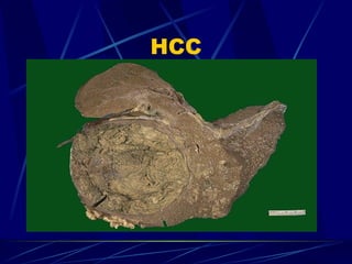 Hepatocellular Carcinoma (Hcc) | PPT
