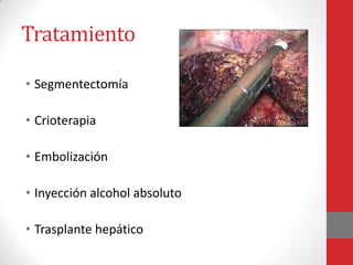 Tratamiento

• Segmentectomía

• Crioterapia

• Embolización

• Inyección alcohol absoluto

• Trasplante hepático
 