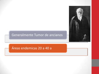 Generalmente Tumor de ancianos


Áreas endemicas 20 a 40 a
 