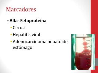 Marcadores
• Alfa- Fetoproteína
  • Cirrosis
  • Hepatitis viral
  • Adenocarcinoma hepatoide
    estómago
 