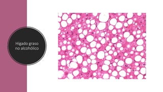 Hígado graso
no alcohólico
 