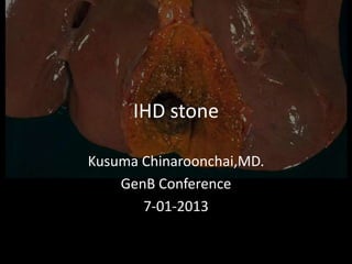 IHD stone
Kusuma Chinaroonchai,MD.
GenB Conference
7-01-2013

 